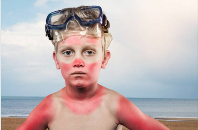 Bild auf dem ein Kind einen schlimmen Sonnenbrand im Gesicht und am Körper hat