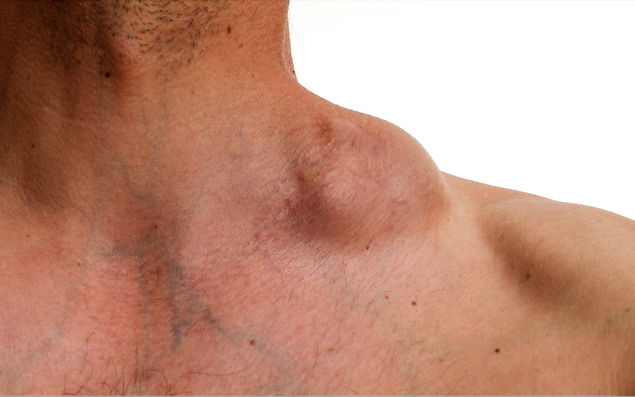 Bild eines vergrößerten Lymphknotens am Hals