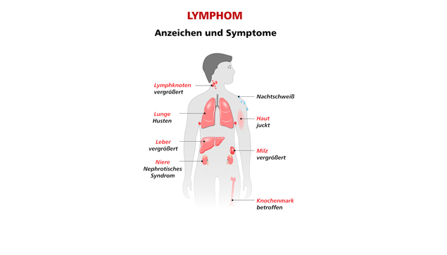Anzeichen und Symptome bei Lymphomen