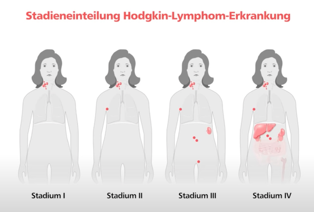 Stadieneinteilung beim Hodgkin-Lymphom