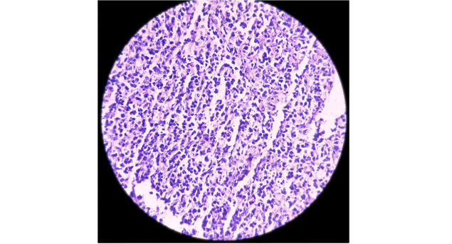 Bild eines Lymphoms unter dem Mikroskop
